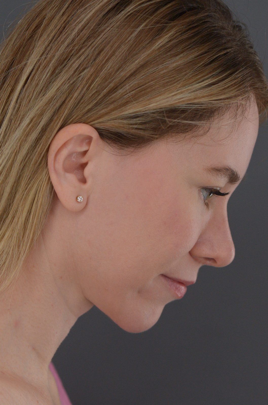 Ponytail Facelift before and after, case 19, view 5 (after)