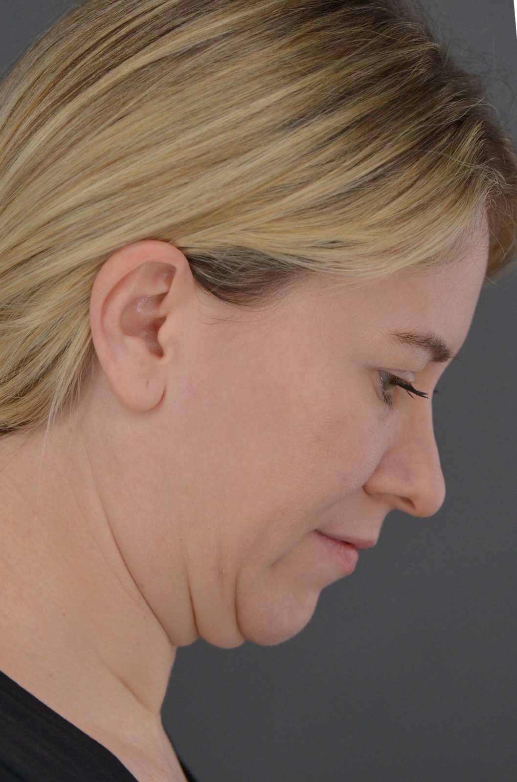 Ponytail Facelift before and after, case 19, view 5 (before)