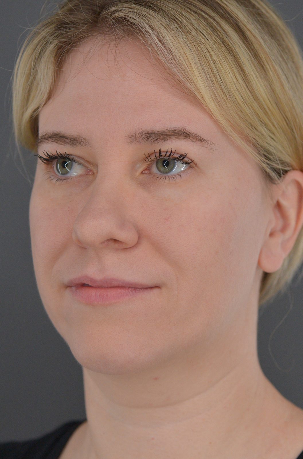 Ponytail Facelift before and after, case 19, view 6 (before)