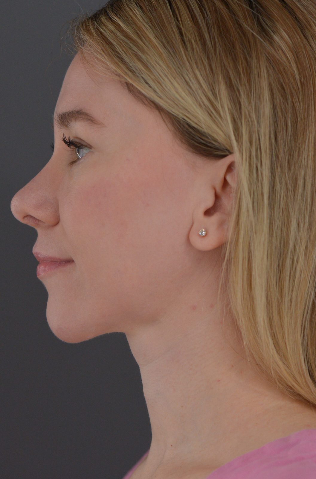 Ponytail Facelift before and after, case 19, view 7 (after)