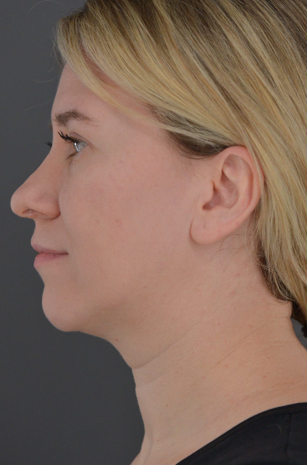 Ponytail Facelift before and after, case 19, view 7 (before)
