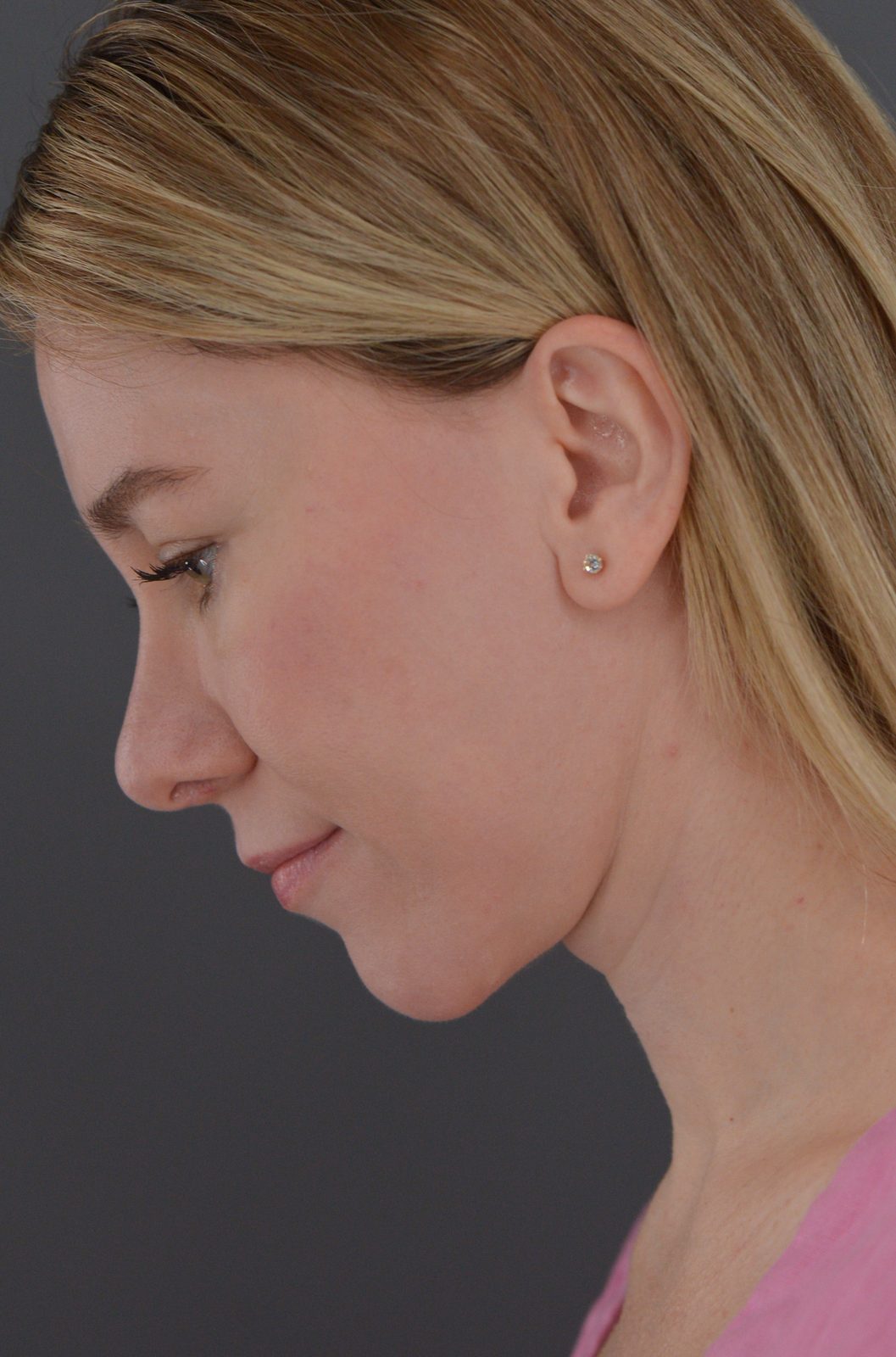 Ponytail Facelift before and after, case 19, view 8 (after)
