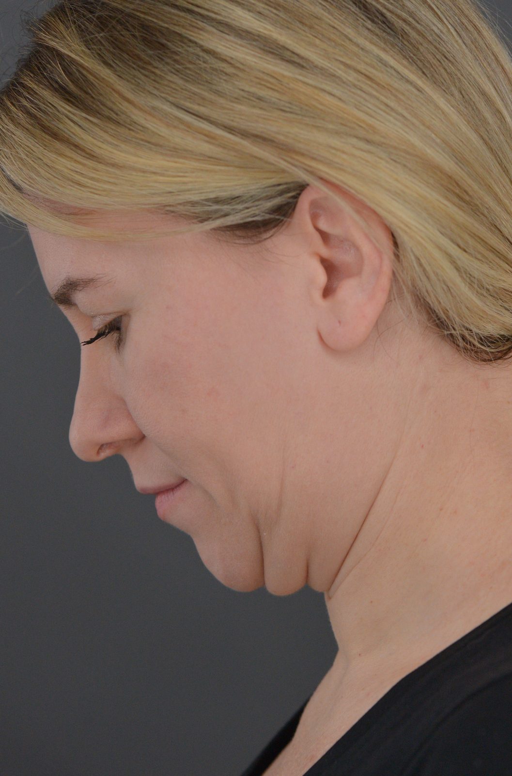 Ponytail Facelift before and after, case 19, view 8 (before)