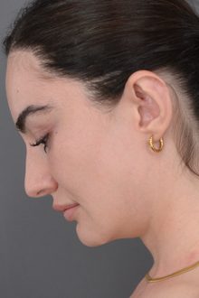 Ponytail Facelift before and after, case 20 (after)