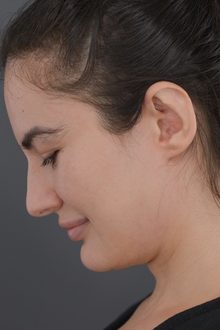 Ponytail Facelift before and after, case 20 (before)