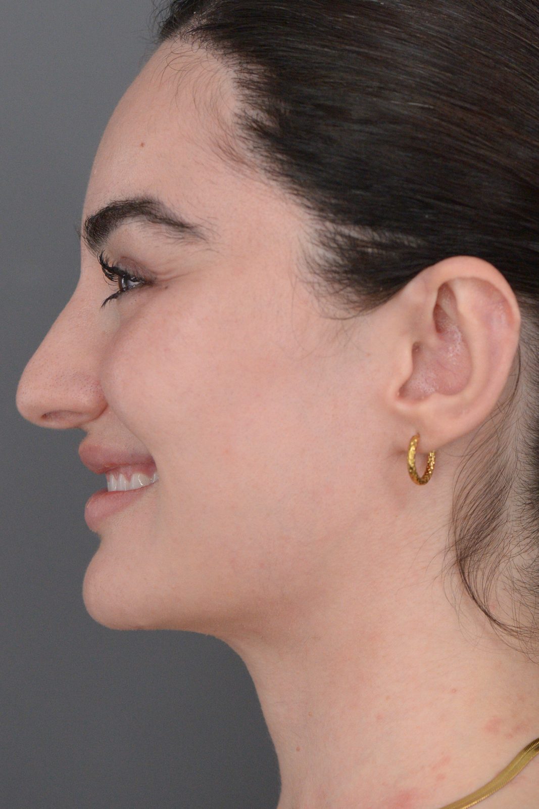 Ponytail Facelift before and after, case 20, view 10 (after)