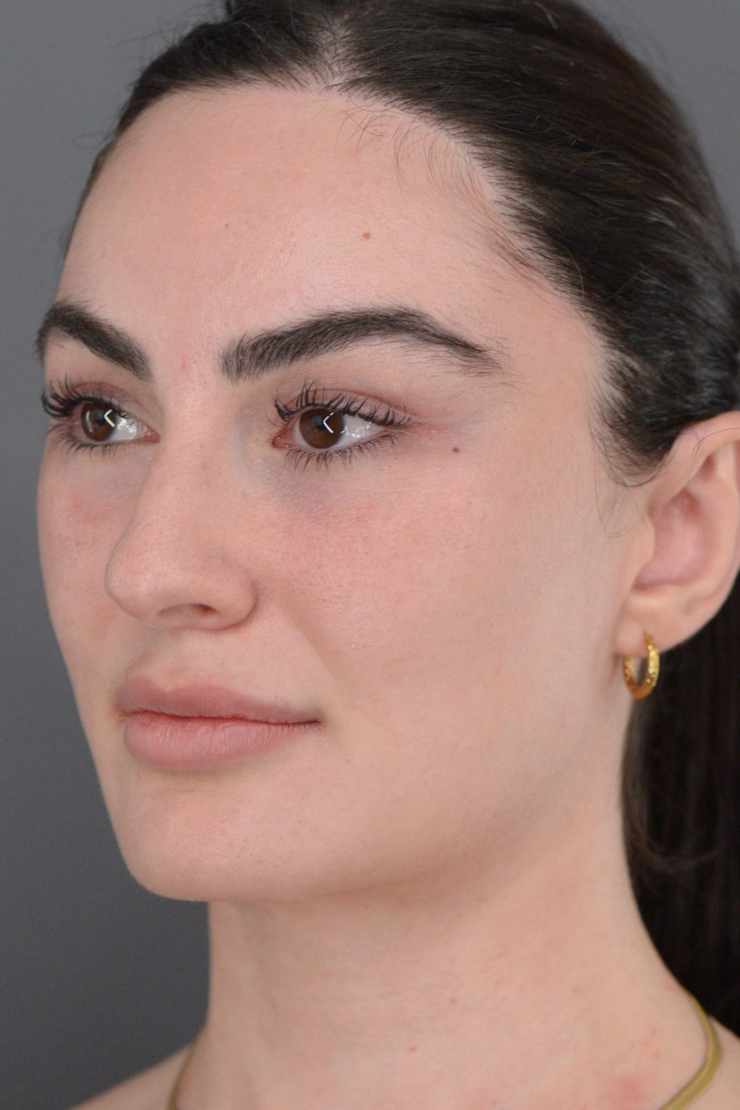 Ponytail Facelift before and after, case 20, view 11 (after)