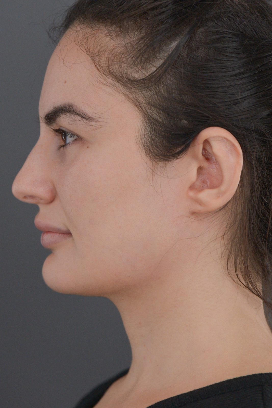 Ponytail Facelift before and after, case 20, view 11 (before)