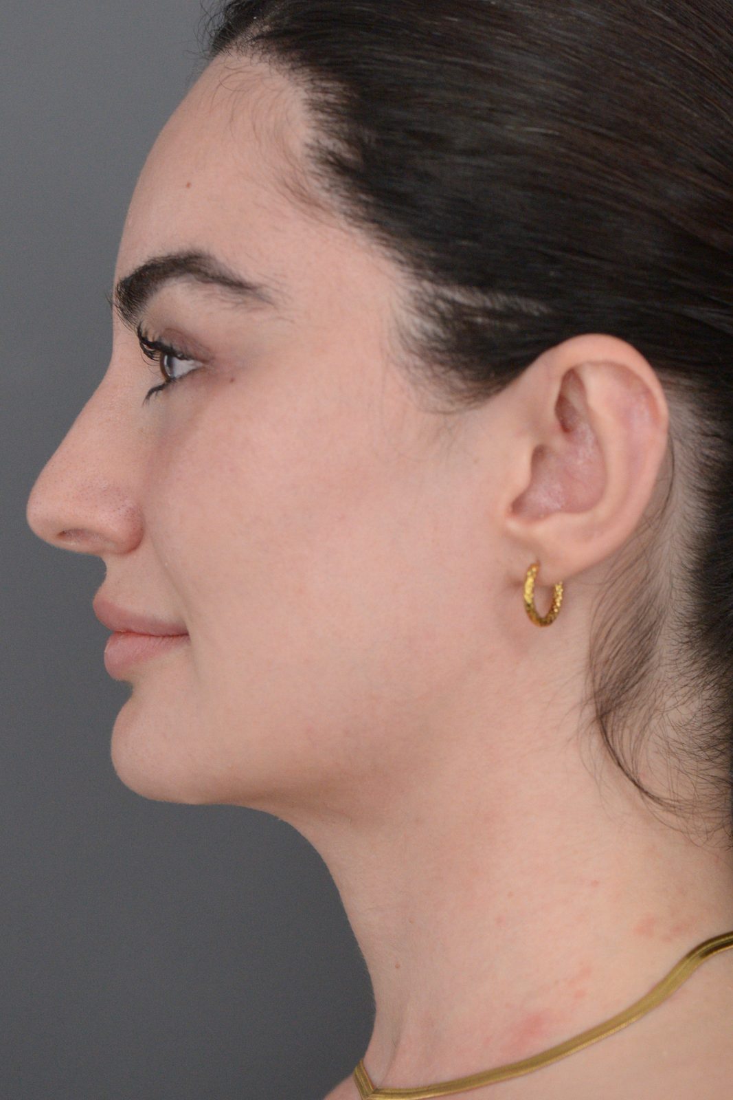 Ponytail Facelift before and after, case 20, view 12 (after)