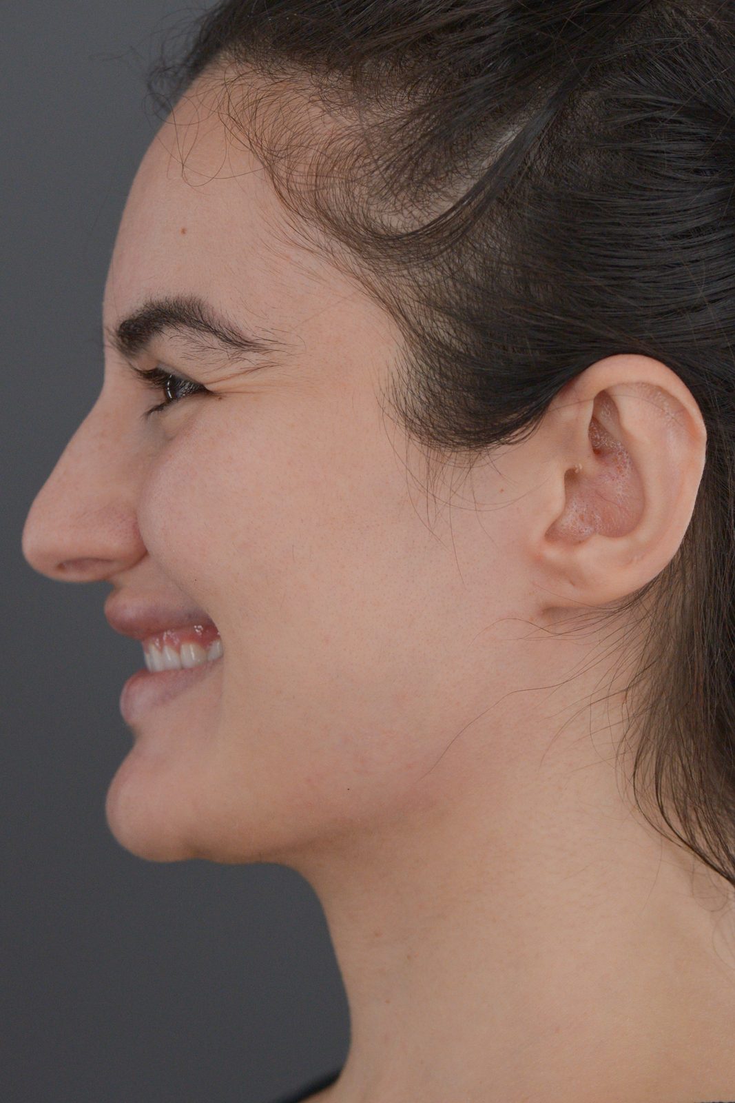 Ponytail Facelift before and after, case 20, view 12 (before)