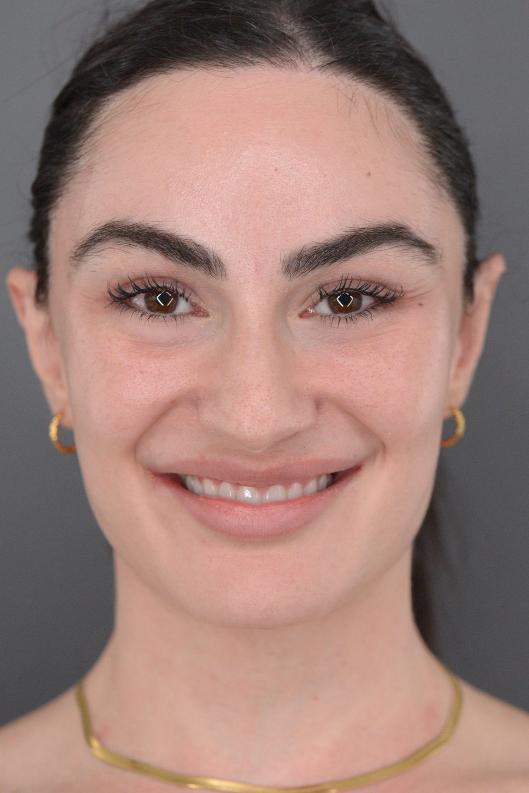 Ponytail Facelift before and after, case 20, view 3 (after)