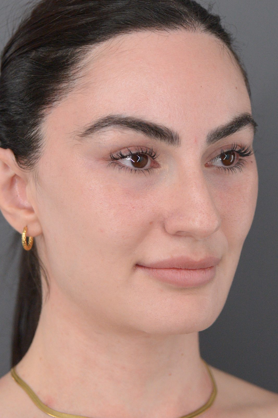 Ponytail Facelift before and after, case 20, view 4 (after)