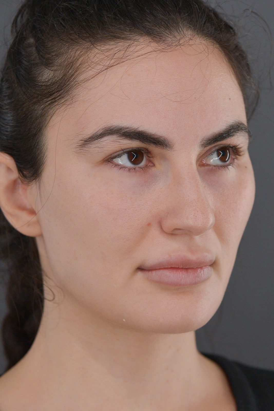 Ponytail Facelift before and after, case 20, view 4 (before)