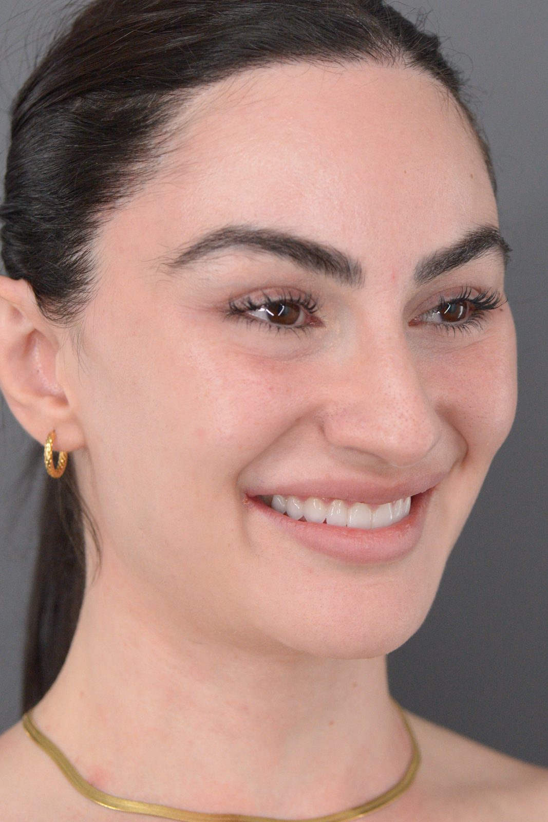 Ponytail Facelift before and after, case 20, view 5 (after)