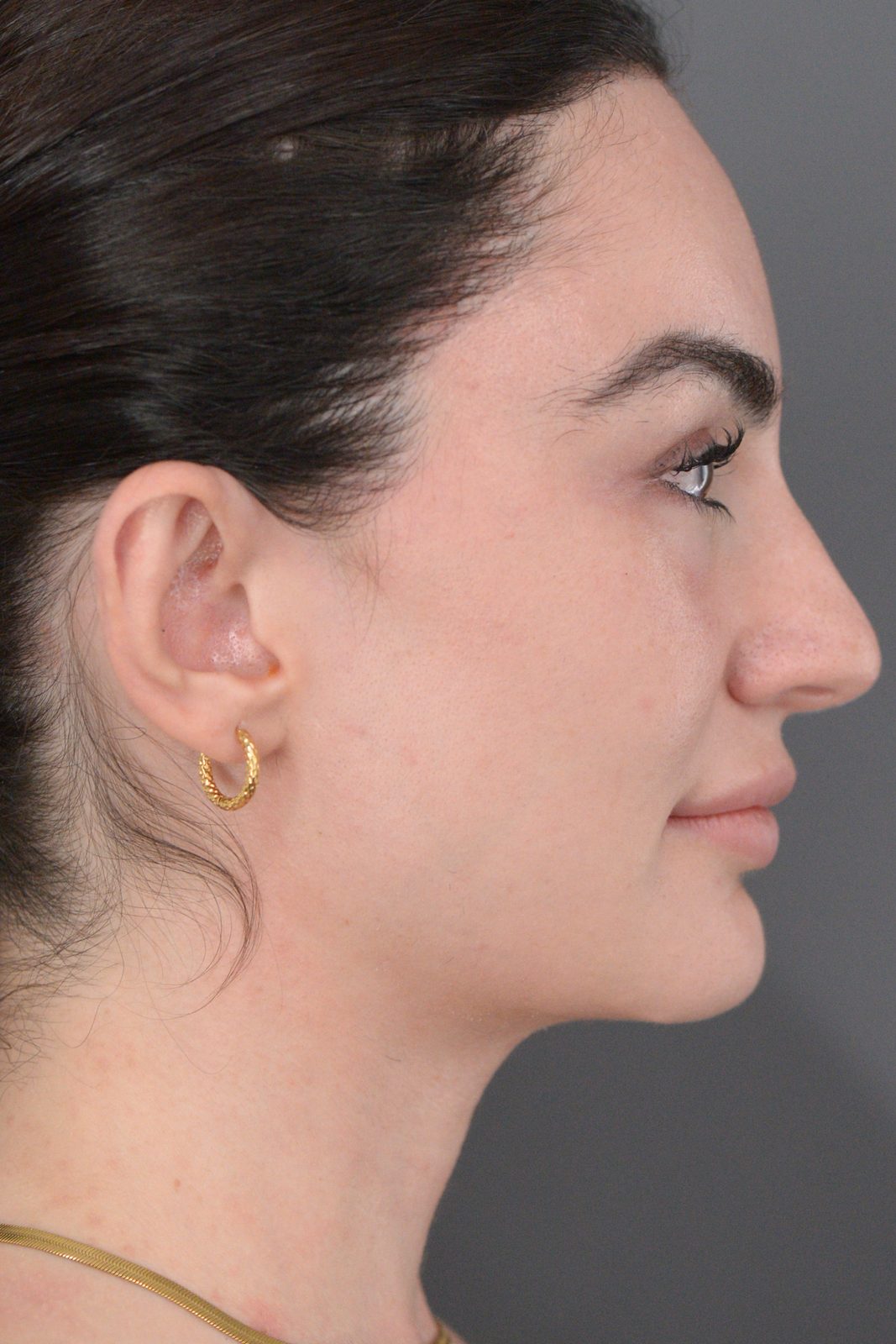 Ponytail Facelift before and after, case 20, view 6 (after)