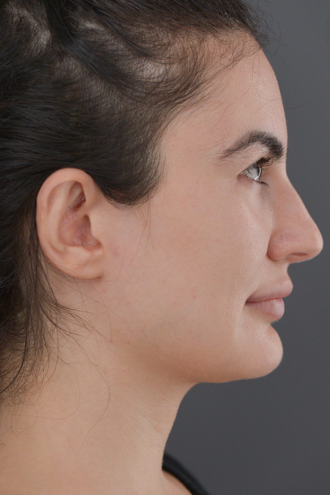 Ponytail Facelift before and after, case 20, view 6 (before)