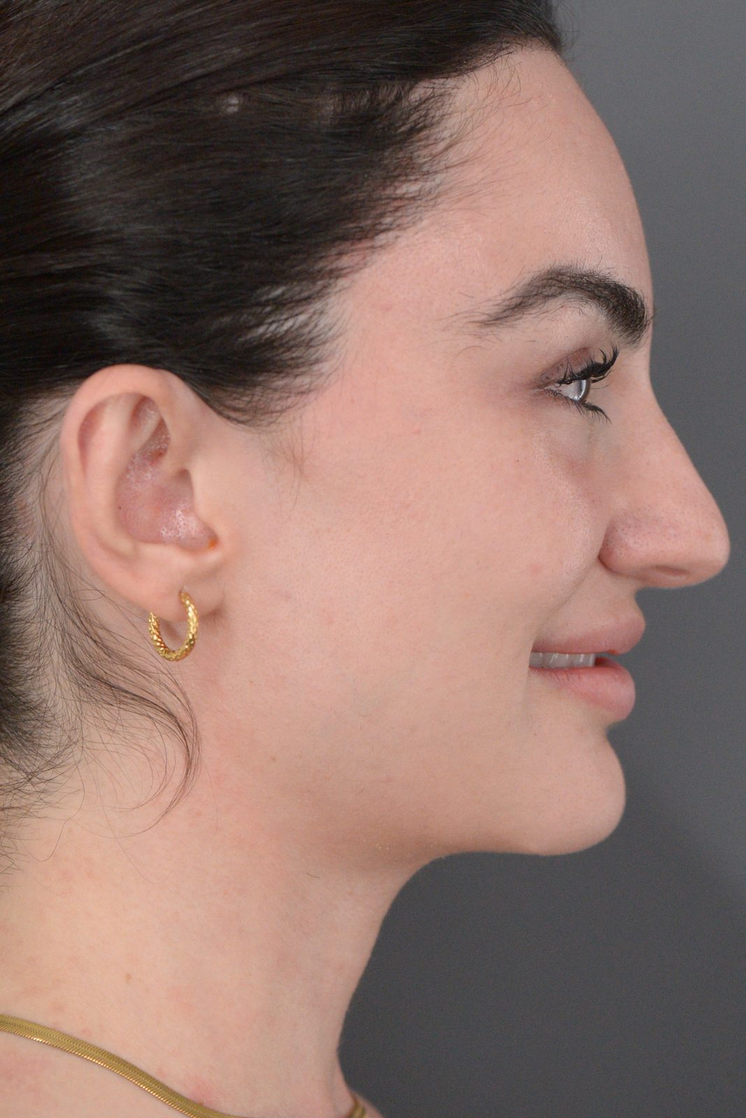 Ponytail Facelift before and after, case 20, view 7 (after)