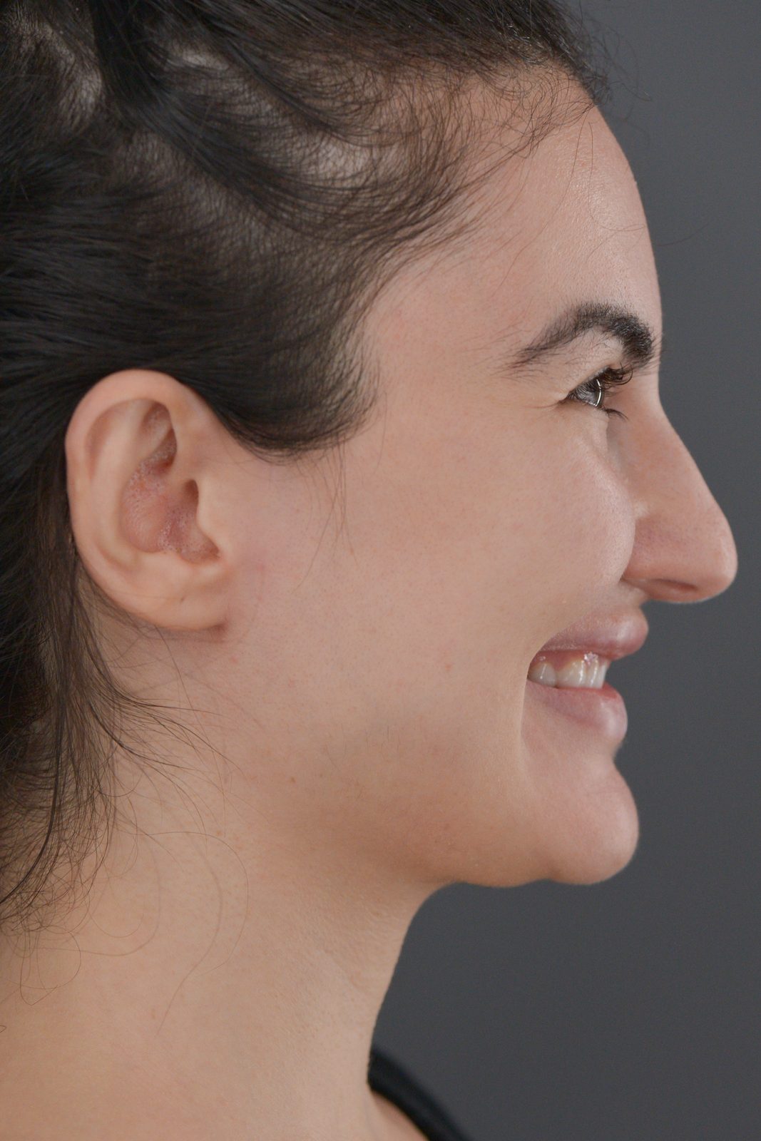 Ponytail Facelift before and after, case 20, view 7 (before)