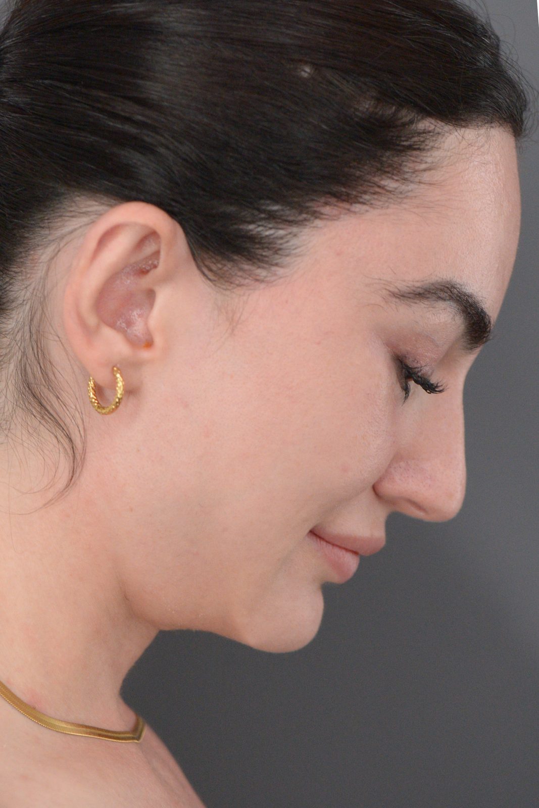 Ponytail Facelift before and after, case 20, view 8 (after)