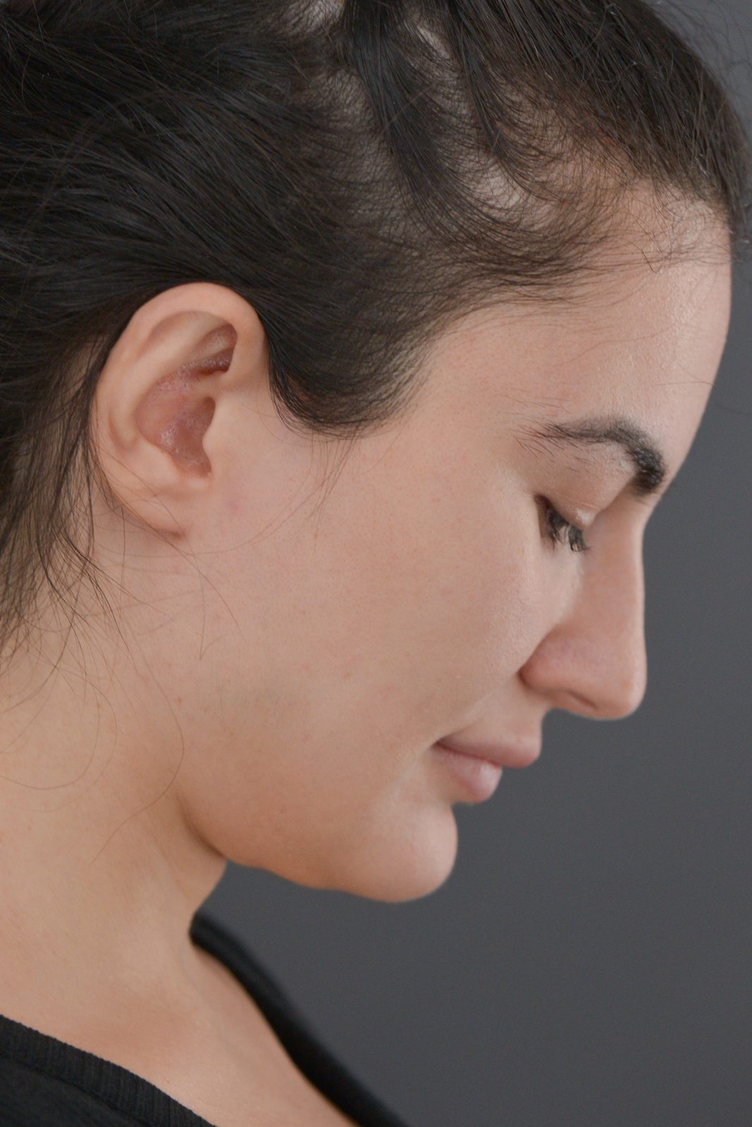 Ponytail Facelift before and after, case 20, view 8 (before)
