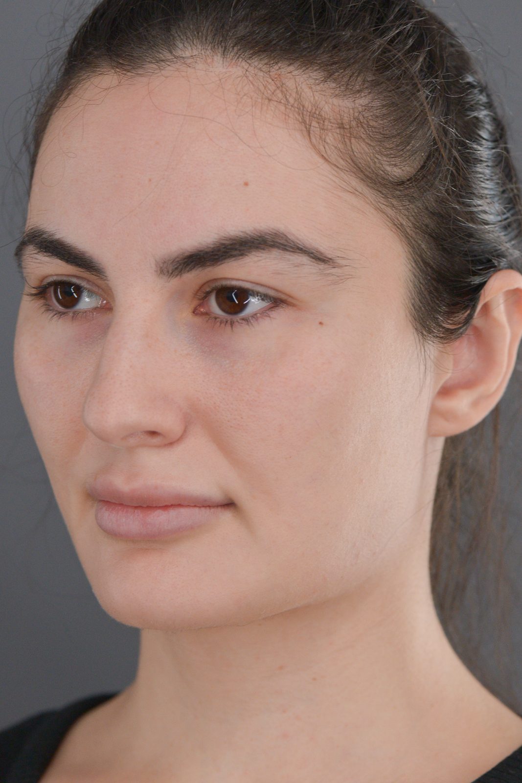 Ponytail Facelift before and after, case 20, view 9 (before)