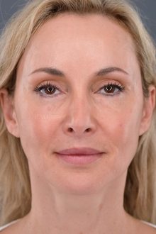 Ponytail Facelift before and after, case 21 (after)