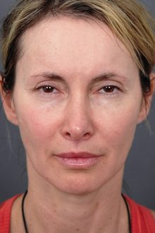 Ponytail Facelift before and after, case 21 (before)