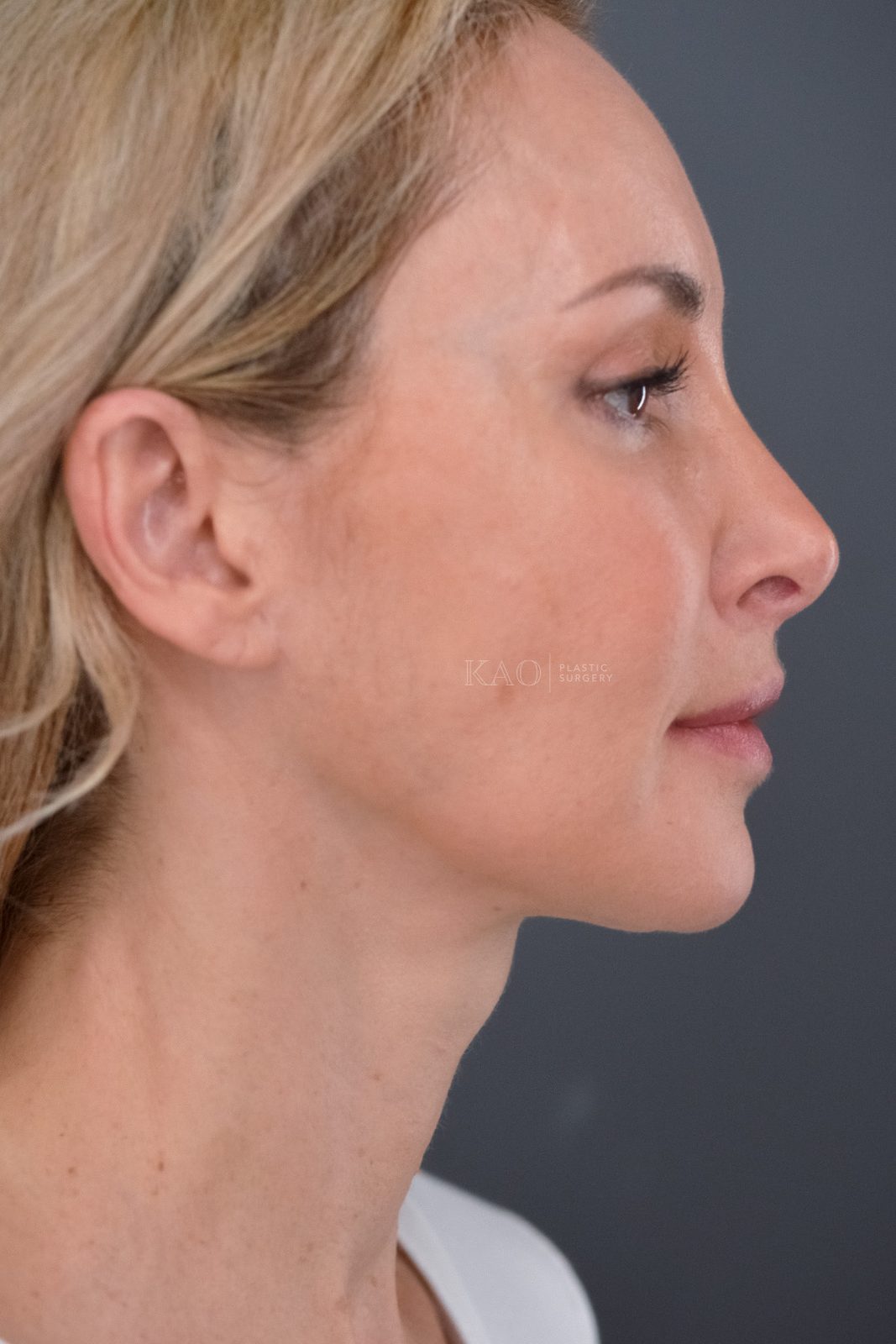 Ponytail Facelift before and after, case 21, view 3 (after)