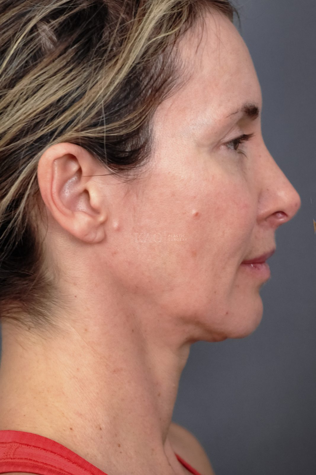 Ponytail Facelift before and after, case 21, view 3 (before)