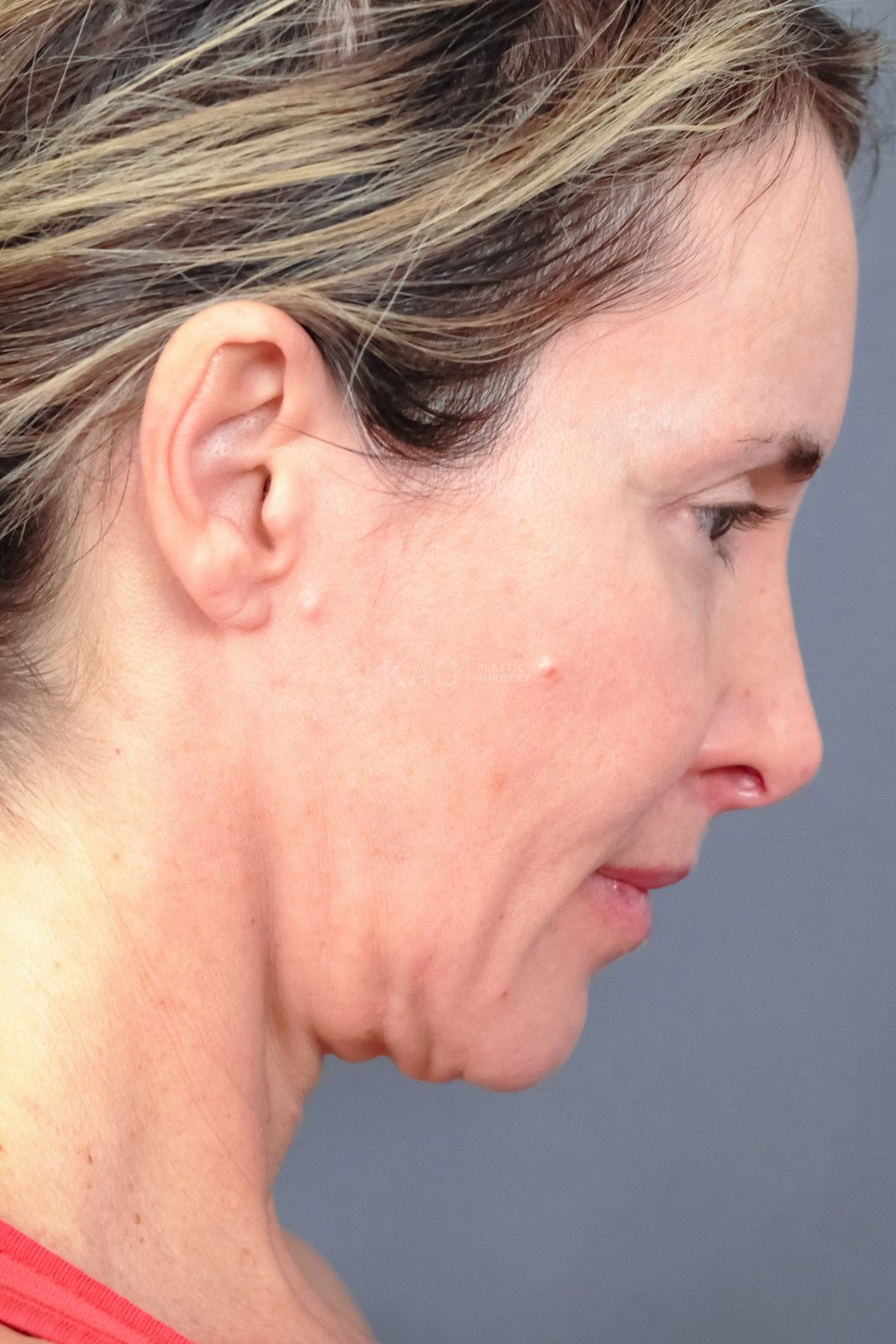 Ponytail Facelift before and after, case 21, view 4 (before)