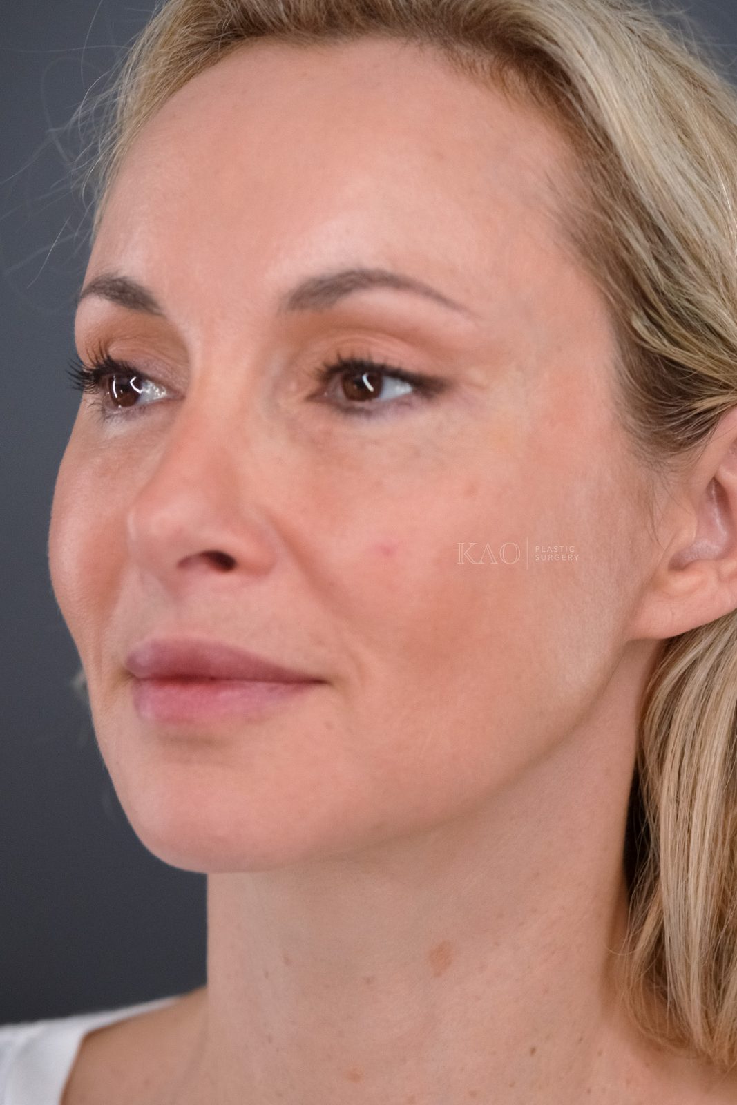 Ponytail Facelift before and after, case 21, view 5 (after)