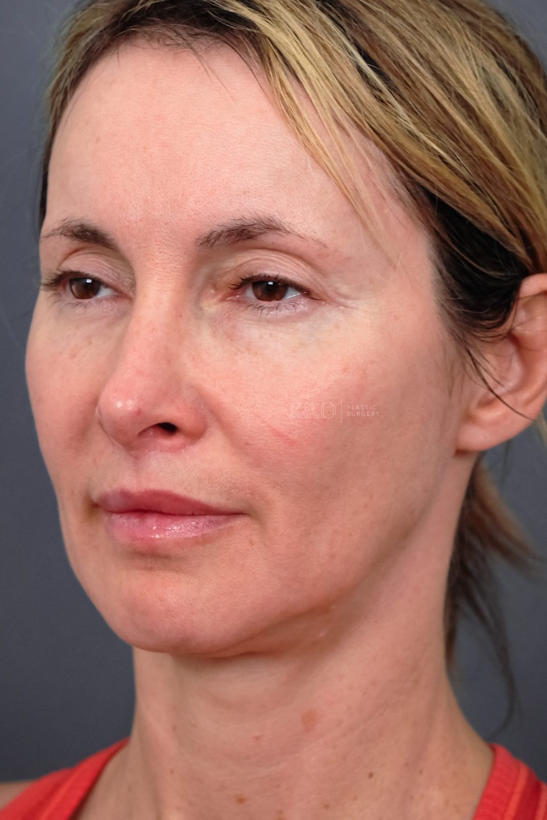 Ponytail Facelift before and after, case 21, view 5 (before)