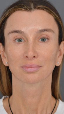 Ponytail Facelift before and after, case 22 (after)