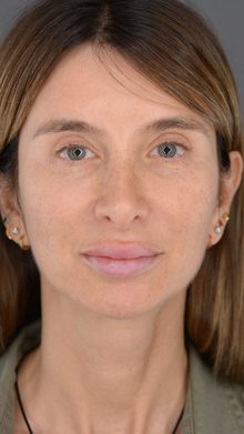 Ponytail Facelift before and after, case 22 (before)