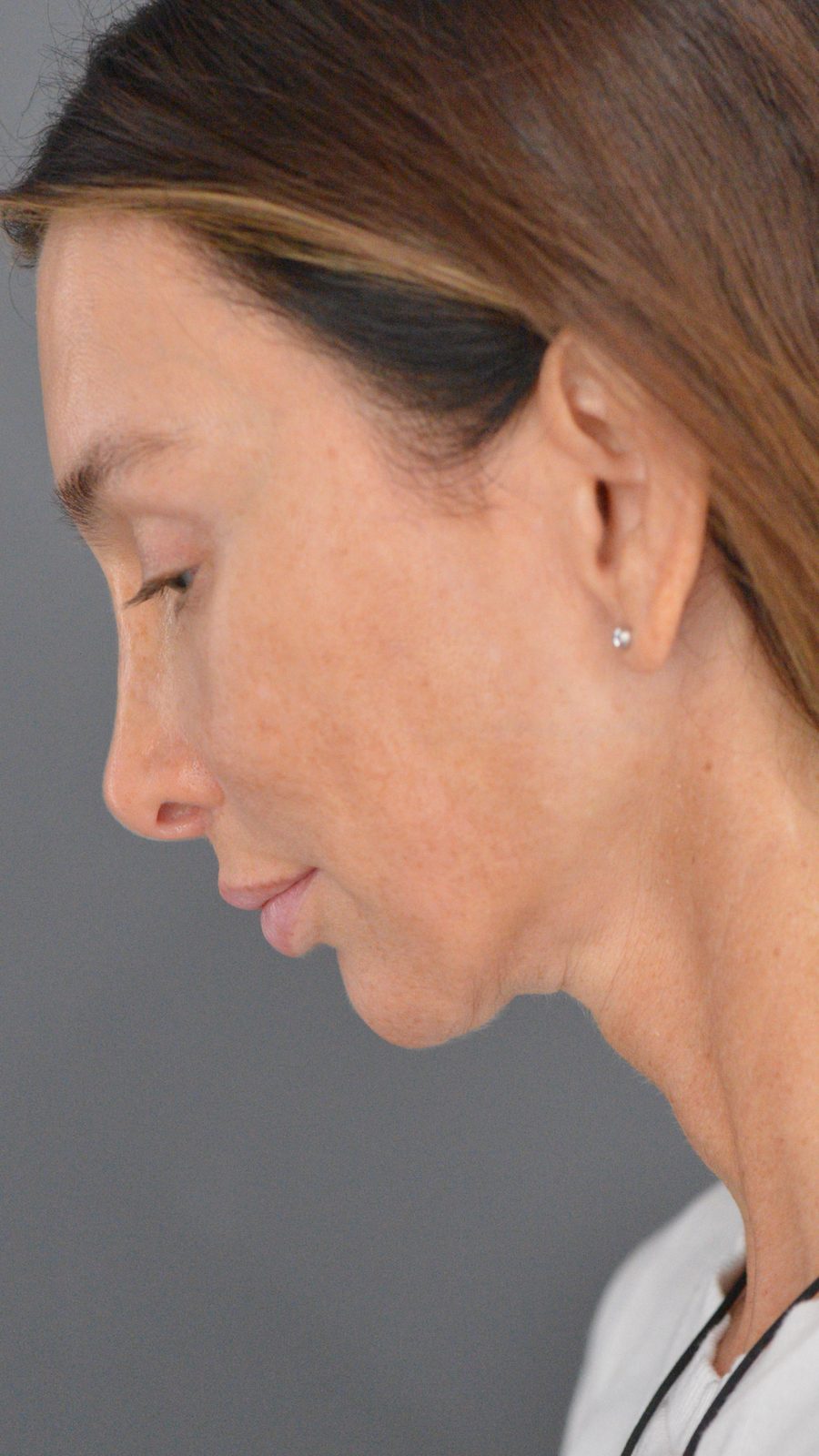 Ponytail Facelift before and after, case 22, view 10 (after)