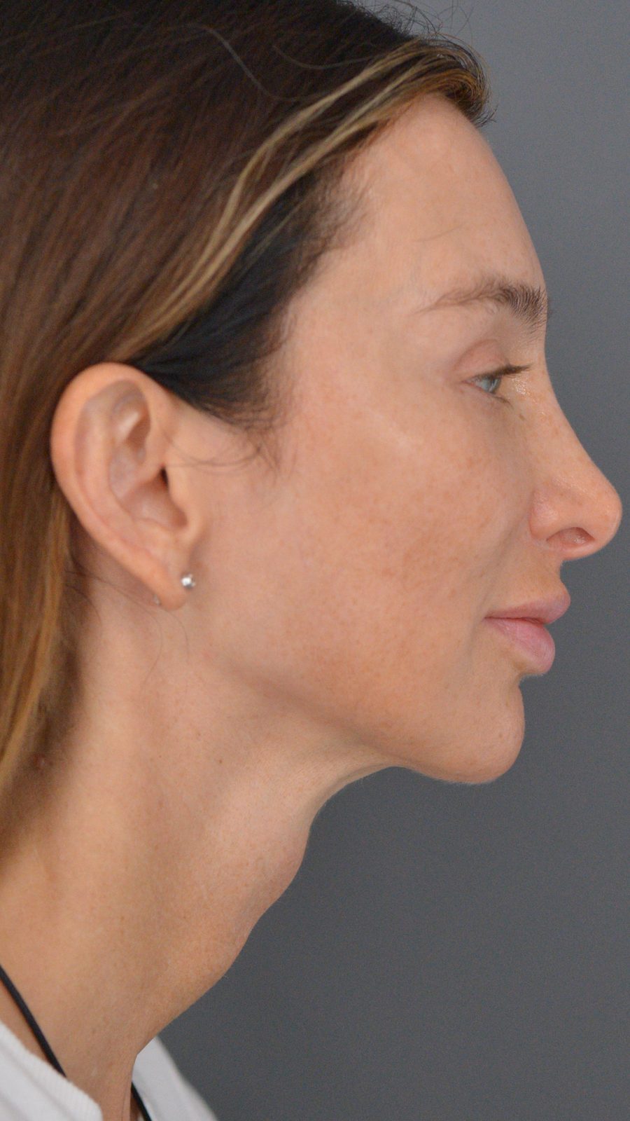 Ponytail Facelift before and after, case 22, view 3 (after)