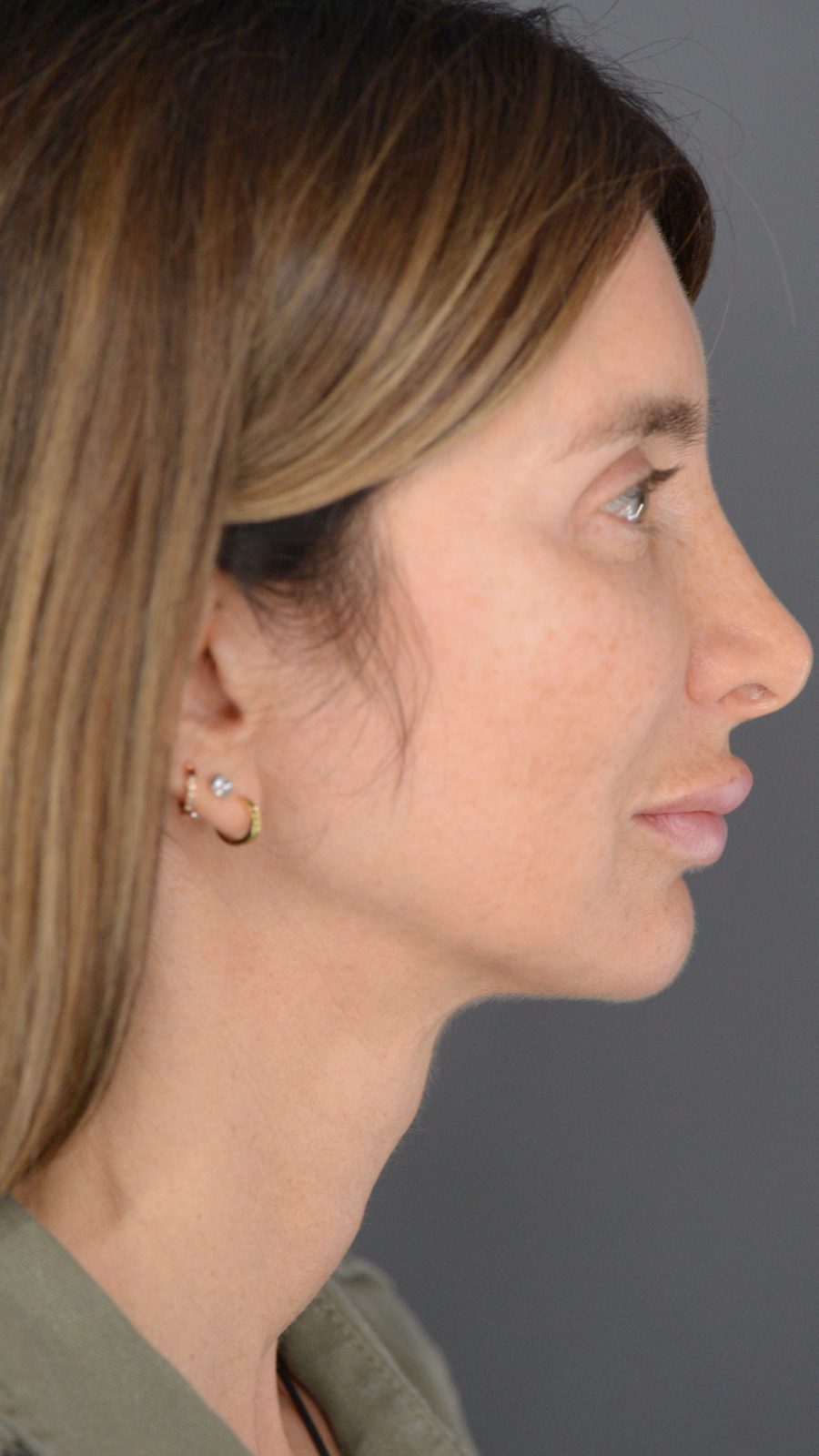 Ponytail Facelift before and after, case 22, view 3 (before)
