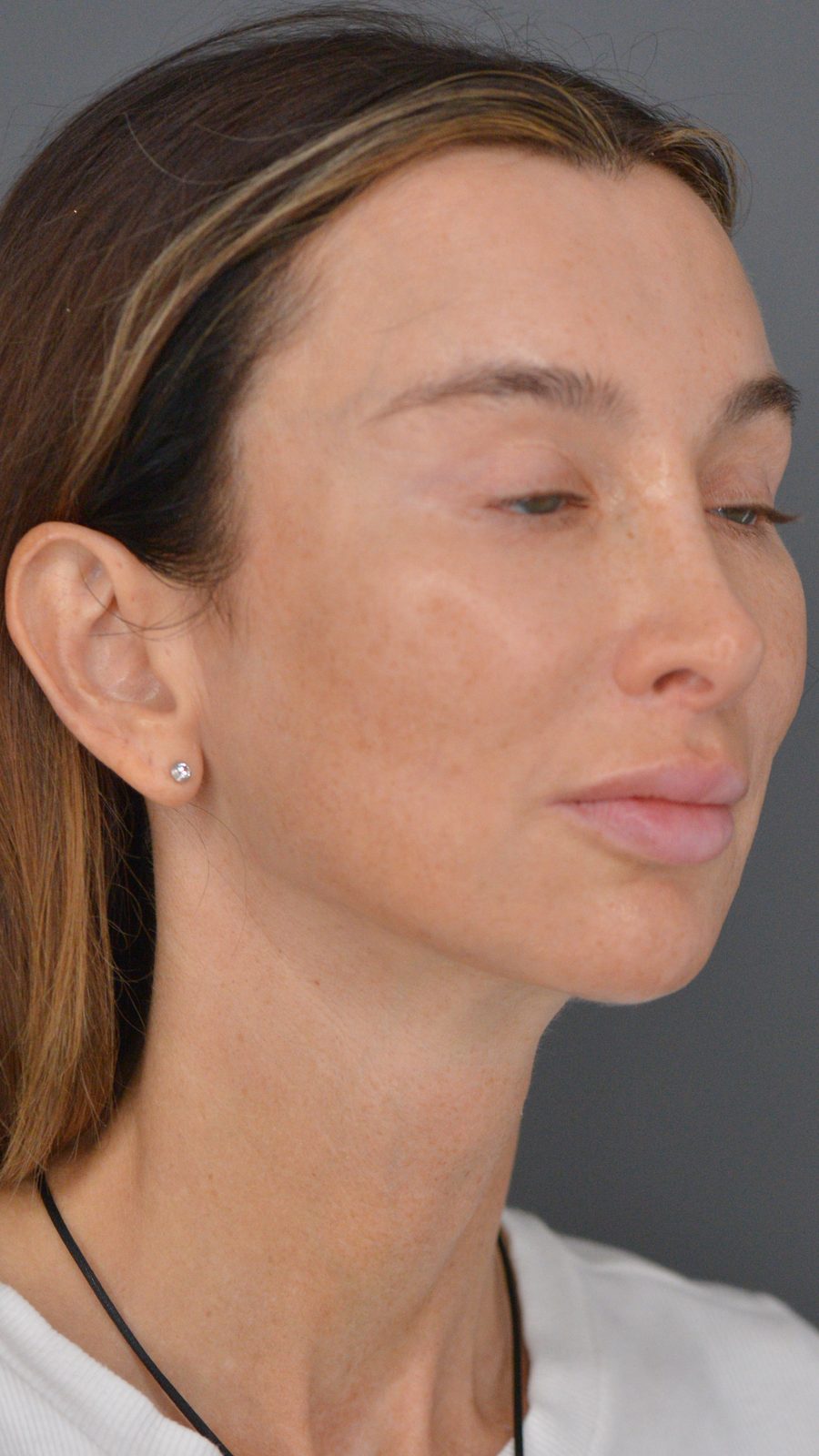 Ponytail Facelift before and after, case 22, view 4 (after)