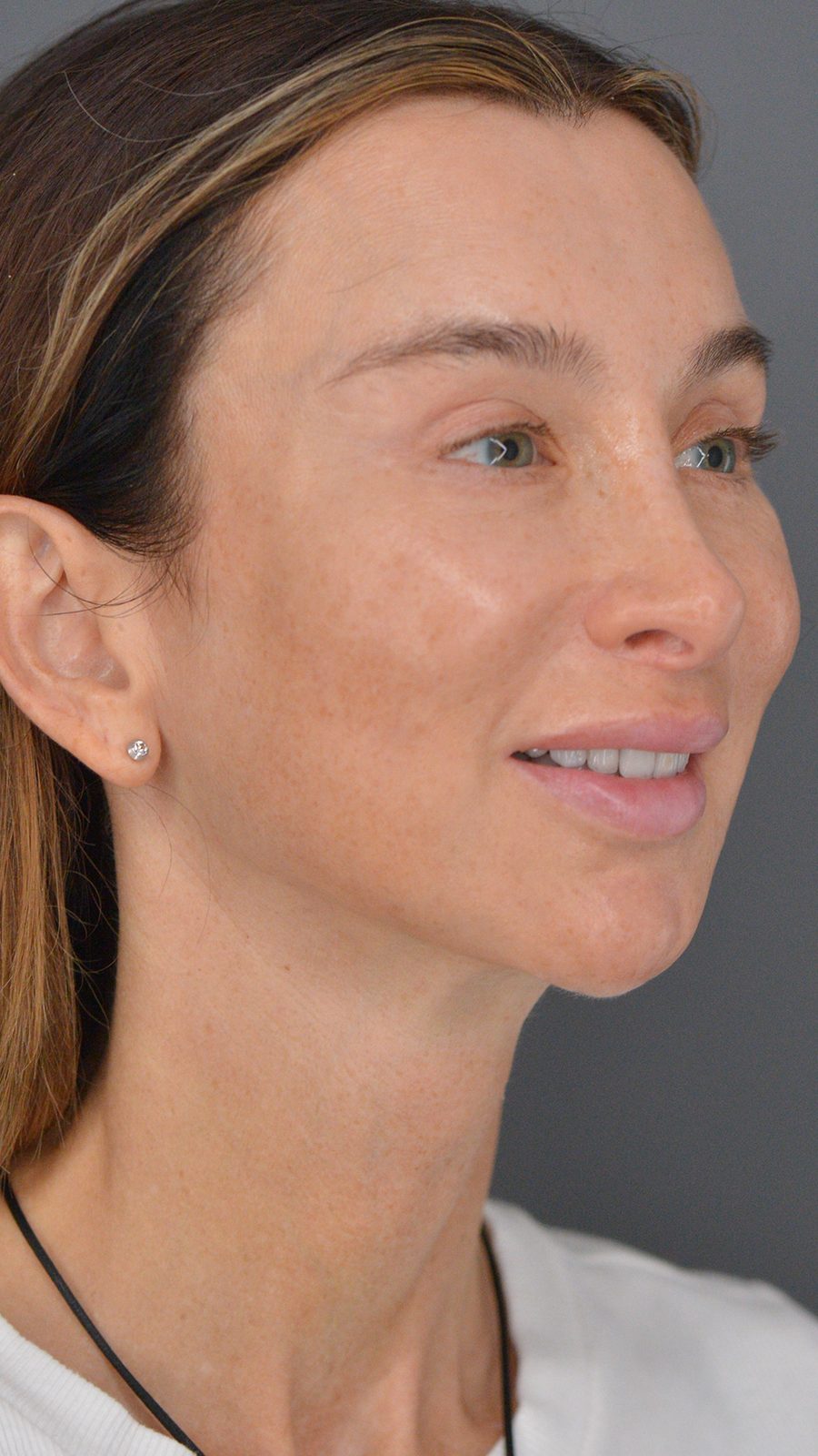 Ponytail Facelift before and after, case 22, view 6 (after)
