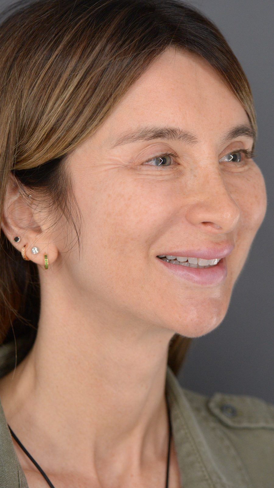 Ponytail Facelift before and after, case 22, view 6 (before)