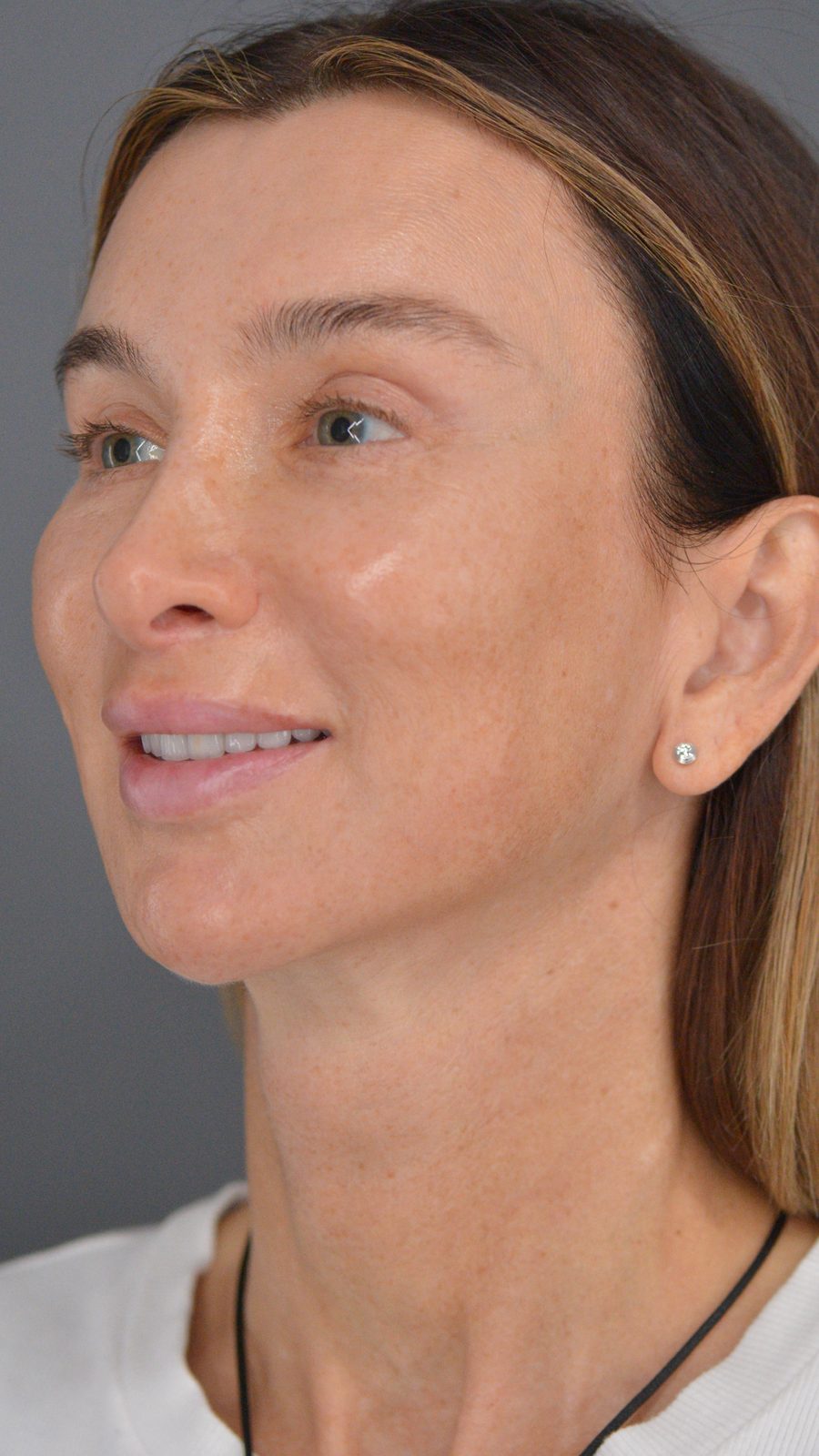 Ponytail Facelift before and after, case 22, view 7 (after)