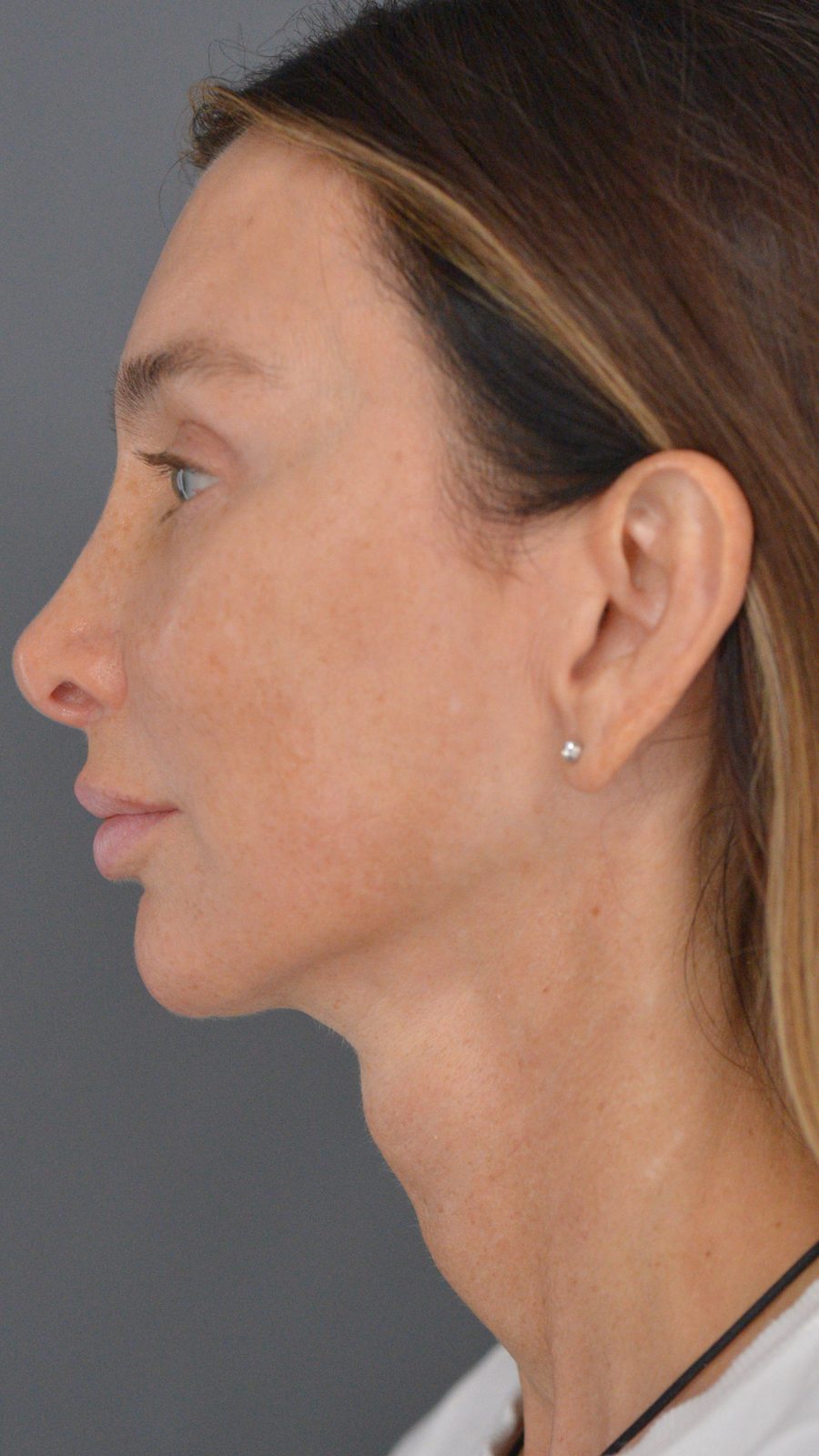 Ponytail Facelift before and after, case 22, view 8 (after)
