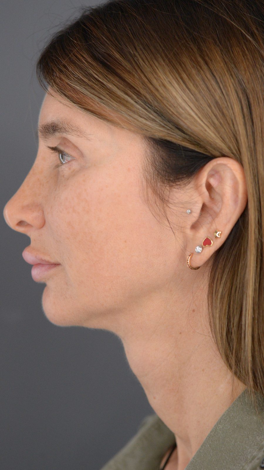 Ponytail Facelift before and after, case 22, view 8 (before)