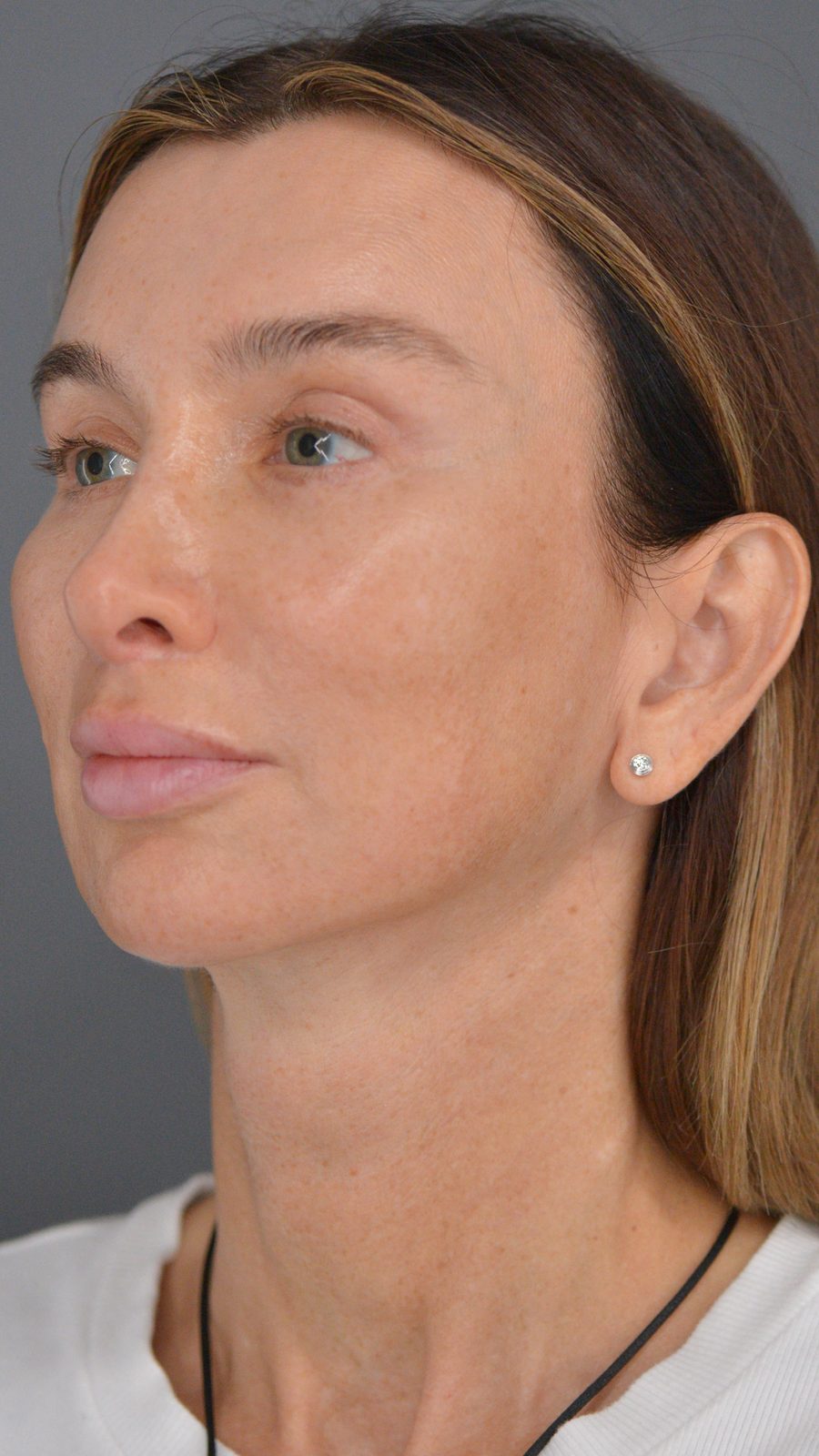 Ponytail Facelift before and after, case 22, view 9 (after)