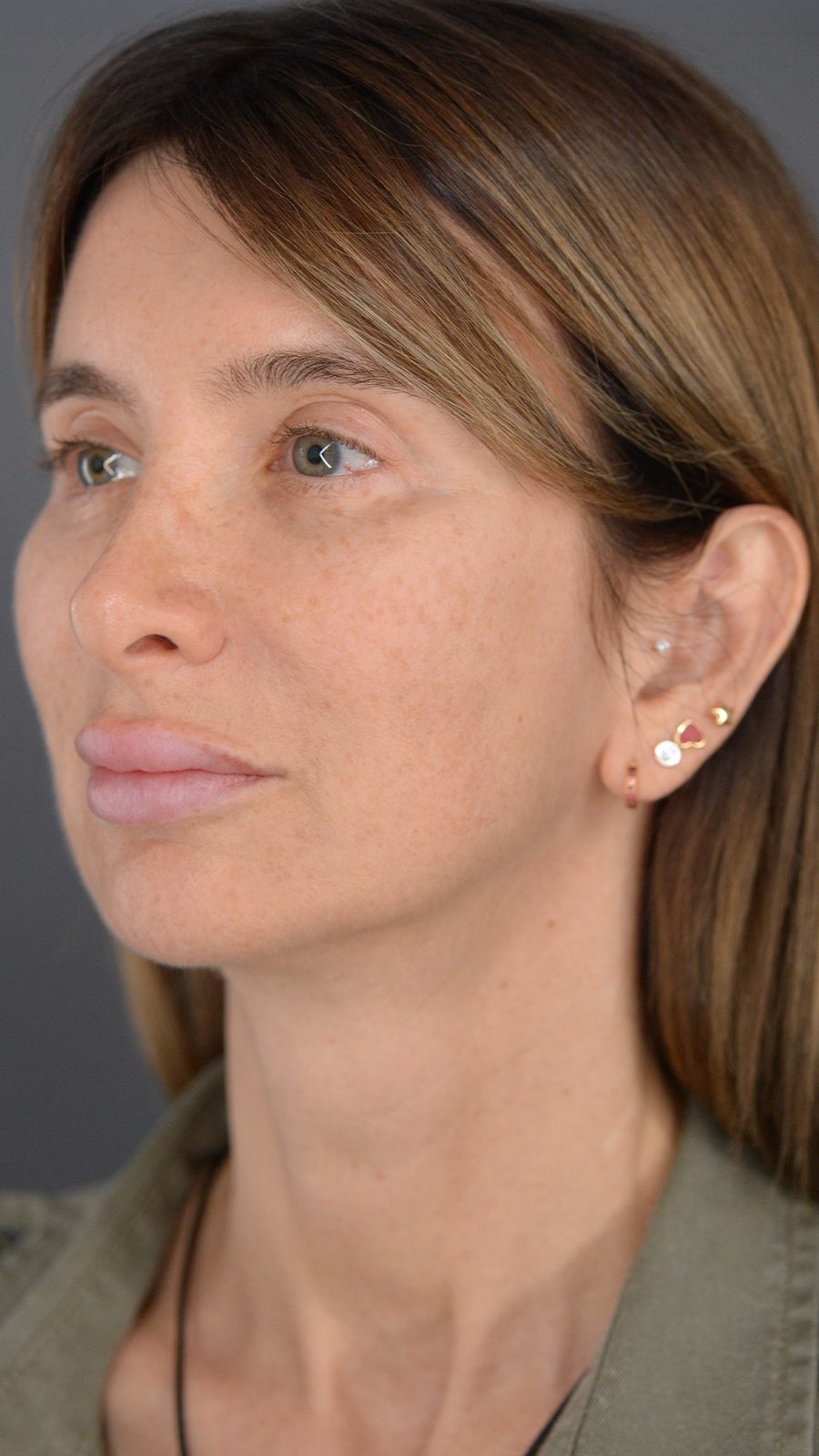 Ponytail Facelift before and after, case 22, view 9 (before)