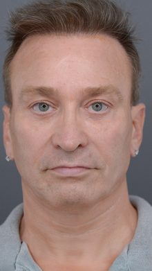 Ponytail Facelift before and after, case 23 (after)