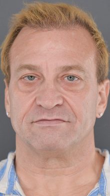 Ponytail Facelift before and after, case 23 (before)