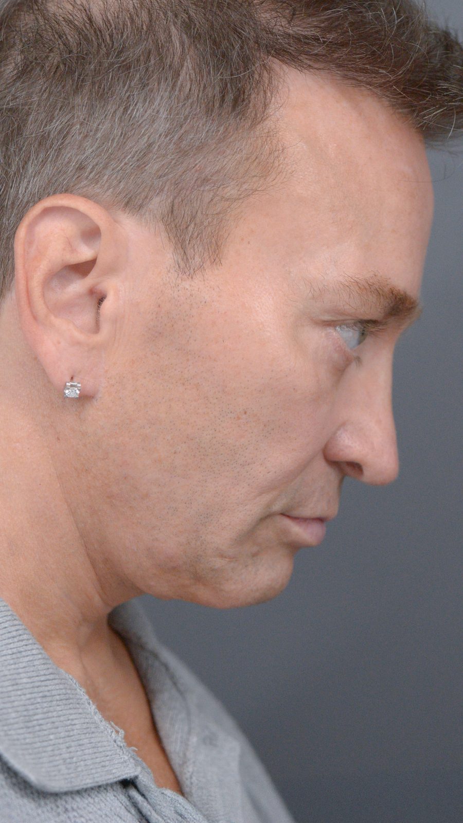 Ponytail Facelift before and after, case 23, view 3 (after)