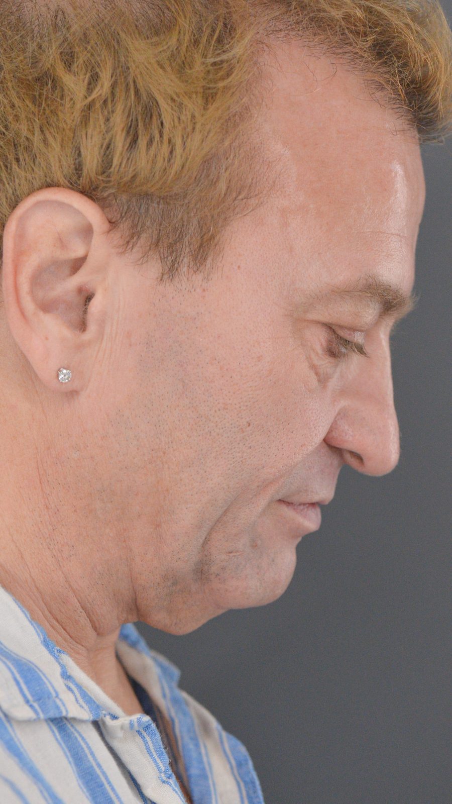 Ponytail Facelift before and after, case 23, view 3 (before)