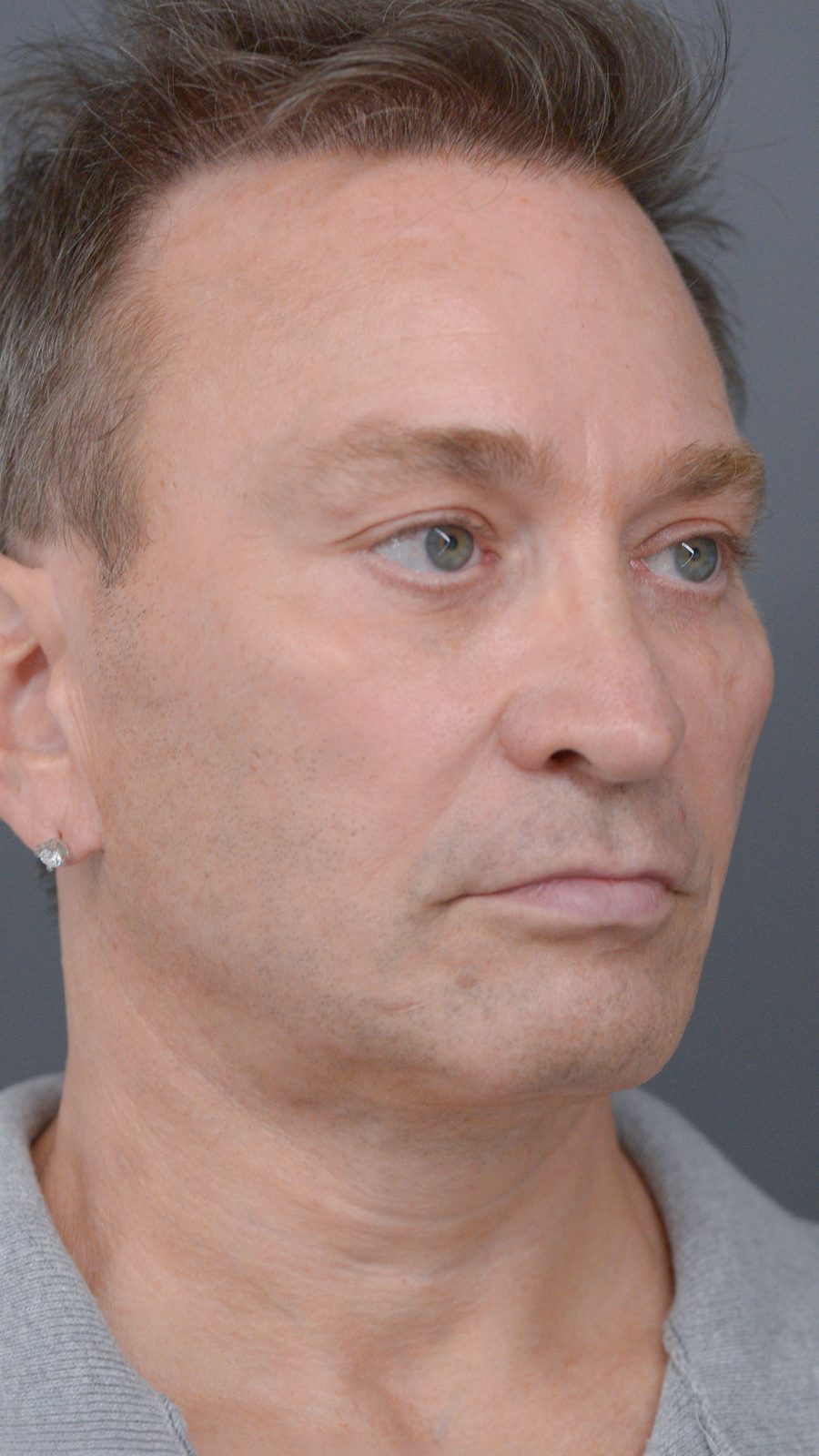 Ponytail Facelift before and after, case 23, view 4 (after)